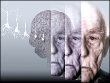 Computer artwork showing the brain of an elderly man affected by Alzheimers disease