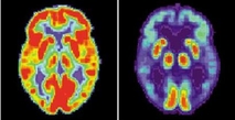 A split-view image showing PET scans of a normal brain (L) and a brain with
